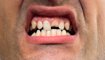 Front Teeth Chipping at Top: Early Warning Signs and Solutions